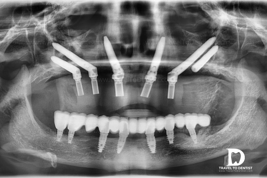 Impianti in resina: scopri i vantaggi dell'implantologia dentale - Studio  Dentistico Dott. Gramaglia