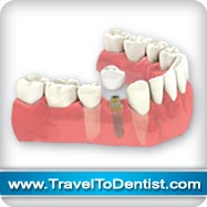 impianti dentali sostituire singoli denti