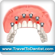 impianti dentali sostituire tutti i denti