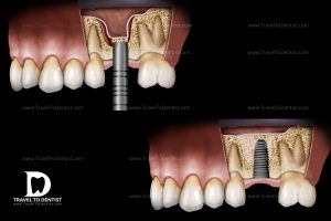 In seguito alla perdita dei denti, l’osso si ritira e bisogna essere ricostruito prima di inserire impianti