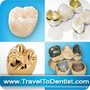 diversi tipi di corone dentali