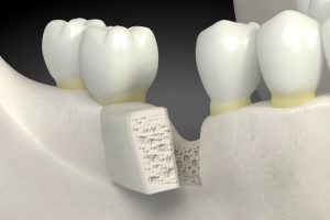 block bone graft