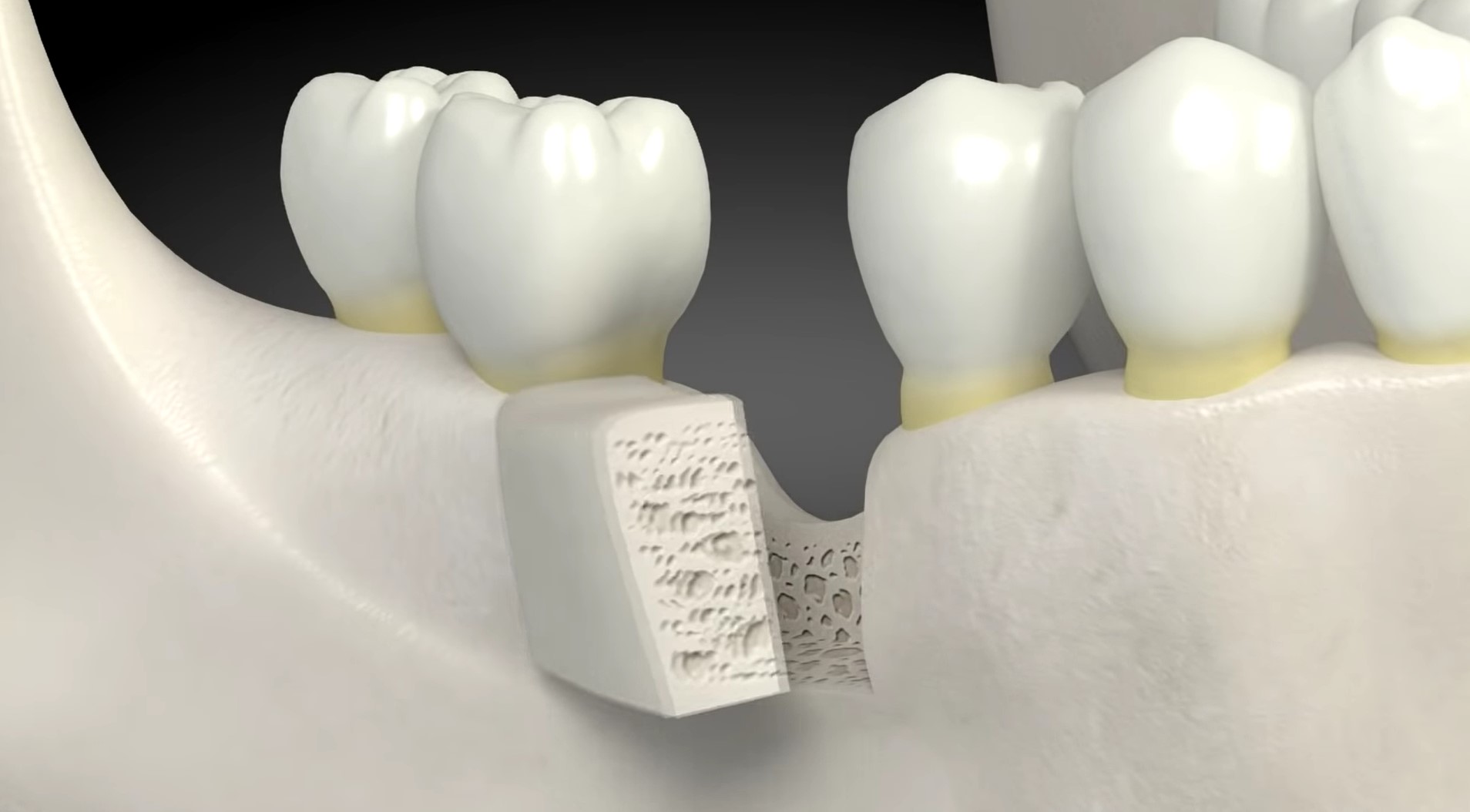 Зуб без кости. Костная пластика (остеопластика). Костная пластика в стоматологии. Винирная костная пластика. Имплантация зубов с костной пластикой.