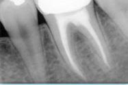 radiografia di un dente devitalizzato ricoperto con una corona dentale