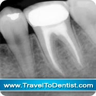radiografia di un dente devitalizzato ricoperto con una corona dentale