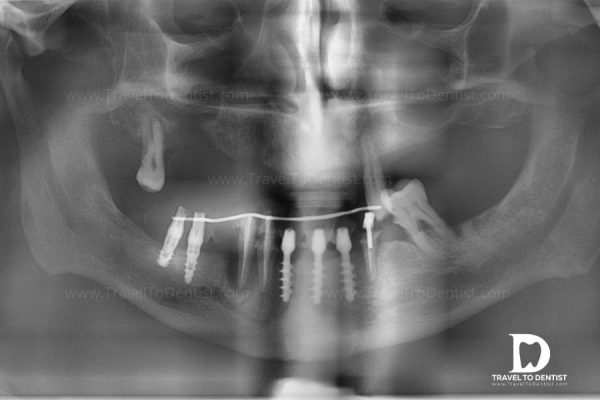 моноблочные зубные имплантаты и традиционные имплантаты, нагруженные одним мостовидным протезом