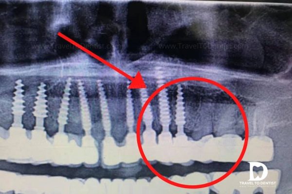 radiografia con impianti dentali monoblocco uniti con i denti naturali e caricati con un ponte dentale definitivo