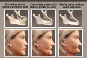 La perdita di denti e ossa modifica il profilo del viso e dà un effetto di invecchiamento