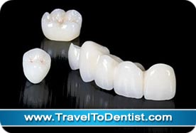 Corona in zirconia, e un ponte in zirconio ceramica