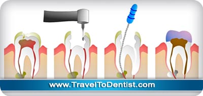 Devitalizzazione dentale processo