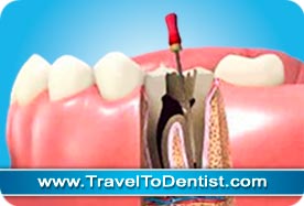 Devitalizzazione dente molare