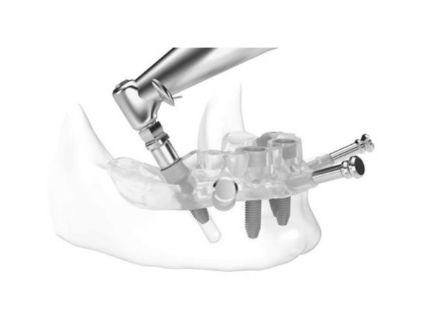 inserarea sigură a implantului dentar la Chișinău folosind ghid chirurgical (șablon chirurgical)