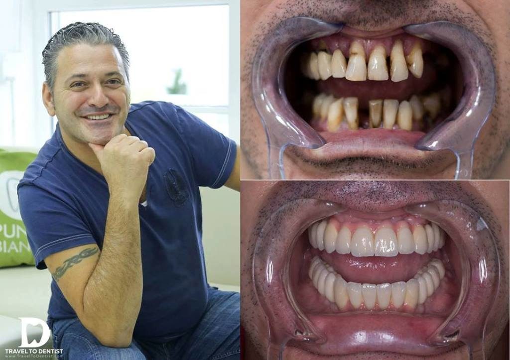 sostituzione tutti i denti con impianti dentali