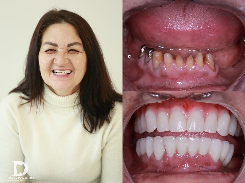 denti fissi su impianti dentali prima e dopo