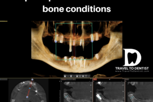 CT - little bone - short dental implants in the lateral areas and long but very thin implants in the area of the frontal teeth, chosen to avoid bone augmentation