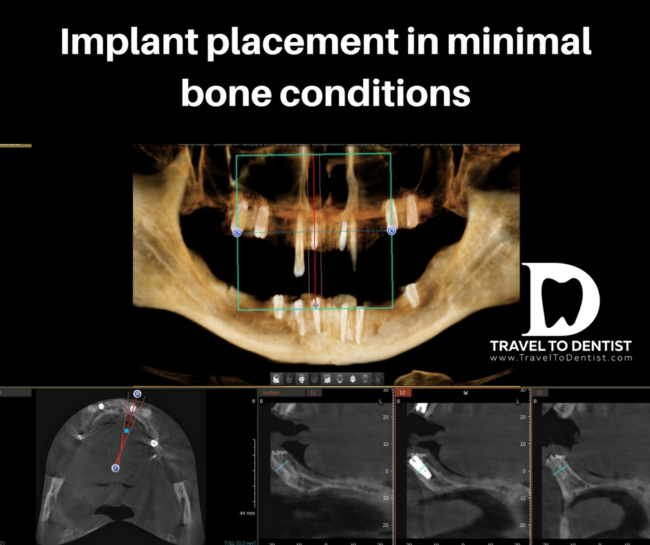 CT - little bone - short dental implants in the lateral areas and long but very thin implants in the area of the frontal teeth, chosen to avoid bone augmentation