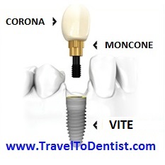 The parts of a dental implant
