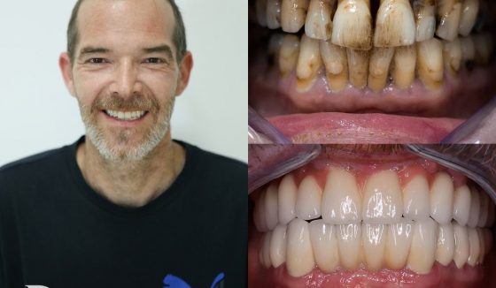 remplacer-toutes-les-dents-implants-dentaires-chisinau Implants dentaires chisinau all on 8