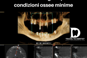 TAC - impianti dentali corti nelle zone laterali e impianti lunghi ma molto sottili nella zona dei denti frontali, scelti cosi per evitare interventi di aumenti ossei