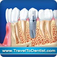 un implante dental