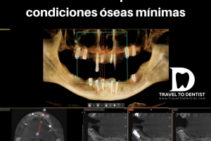 CT: implantes dentales cortos en las áreas laterales e implantes largos pero muy delgados en el área de los dientes frontales, elegidos para evitar el aumento óseo