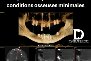 CT - implants dentaires courts dans les zones latérales et implants longs mais très minces dans la région des dents frontales, choisis pour éviter l'augmentation osseuse