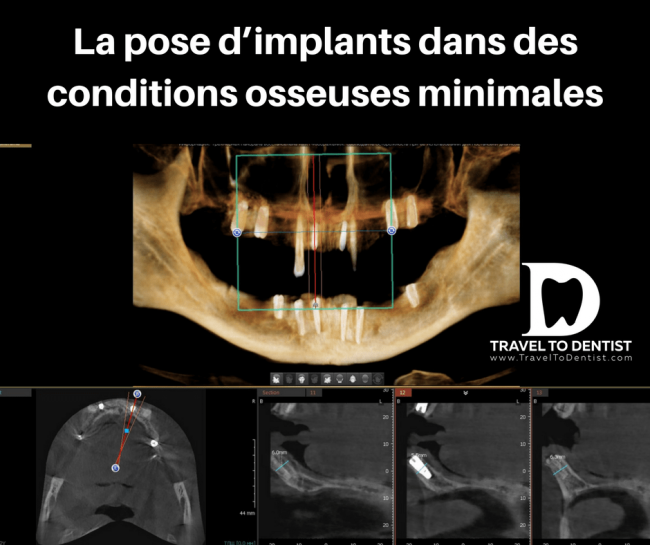 CT - implants dentaires courts dans les zones latérales et implants longs mais très minces dans la région des dents frontales, choisis pour éviter l'augmentation osseuse