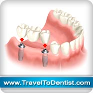 implants dentaires remplace quelques dents