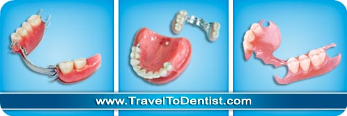 protesis dental parcial removible