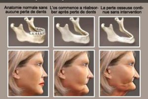 La perte des dents et des os modifie le profil du visage et donne un effet vieillissant.