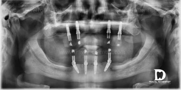 Radiografiá: Puentes provisionales fijos en los implantes dentales. Hecho en Moldavia