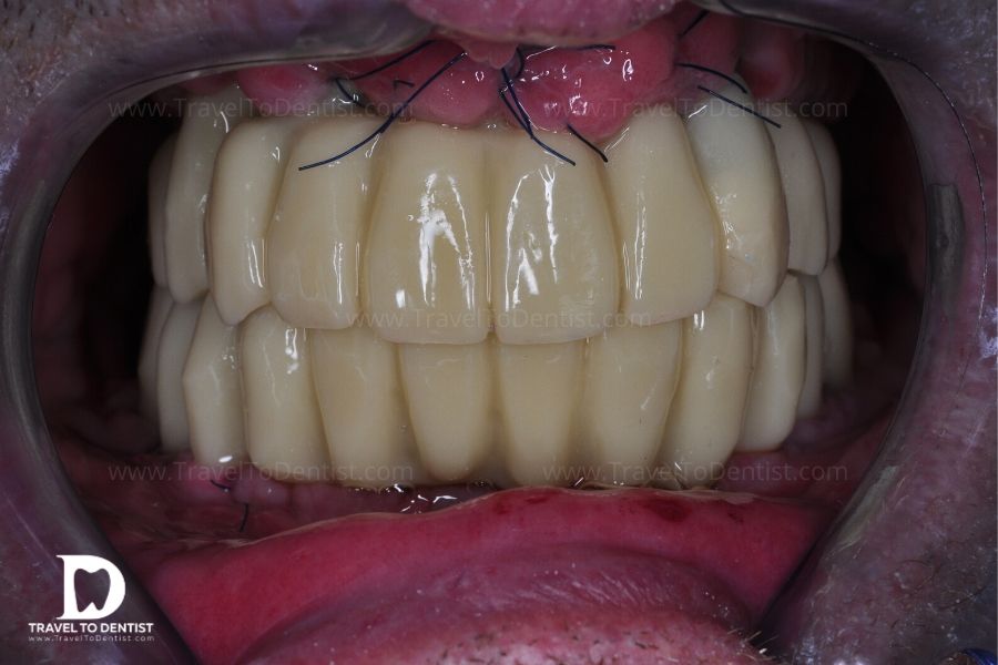 temporary bridges on dental implants
