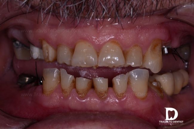 Foto von abgenutzten Zähnen eines Patienten mit Bruxismus, der sich in Moldawien einer complexen zahnärztlichen Rehabilitationsbehandlung unterziehen wird.