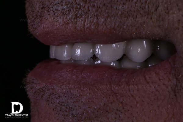 una hermosa foto de los nuevos dientes sobre implantes