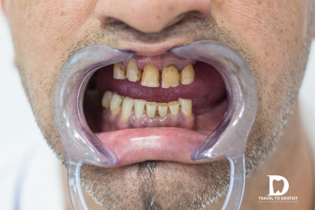 Partieller Zahnlosigkeit - der Mund des Patienten mit mehreren fehlenden Zähnen