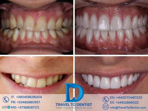 Facettes dentaires à Chișinău. Photos avant et après + sourire de bonheur