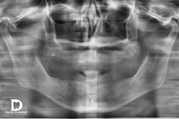 Radiographie: toutes les dents manquantes, mais de l'os suffisant pour l'implantation