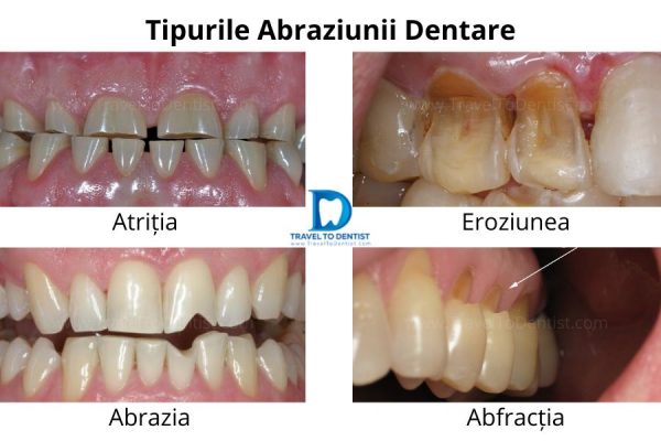 collage con los tipos de abrasión dental: Atritis, Erosión, Abrasión y Abfracción