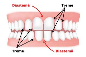 Trema and diastema: Widely spaced teeth on both jaws