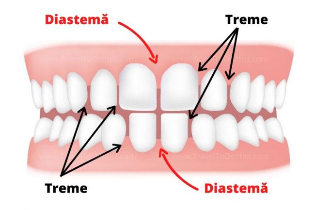 Trema und Diastema: Zahnlücke an beiden Kiefern