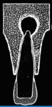 Imaginea radiotransparentă a unui dinte afectat de periodontită. Observăm un sac rotund de culoare neagră și dimensiune mare, bine conturat de un inel la apexul dintelui ce indică forma chistică a periodontitei sau chistul apical. 