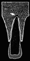 Das strahlungsdurchlässiges Bild eines Zahns, der von Parodontitis betroffen ist. Wir bemerken ein schwarzes Segment an der Zahnspitze, das auf die fibröse Form der Parodontitis hinweist. 