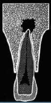 Imagen radiotransparente de un diente afectado por periodontitis. Notamos una bola negra más grande en el ápice del diente que indica la forma granular de periodontitis o granuloma apical. 
