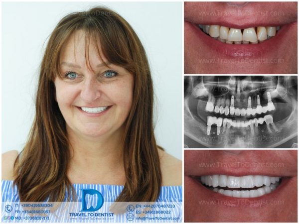 Înainte și după tratament parodontoză în Chișinău. Rezultat: Coroane dentare din zirconiu-ceramică, radiografia de control și Foto cu zâmbetul de fericire