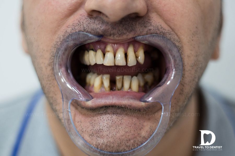 La periodontitis encabeza la lista de problemas de salud pública