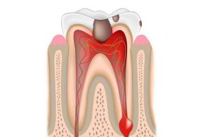 Periodontitis (inflammation at the tip of the tooth root)