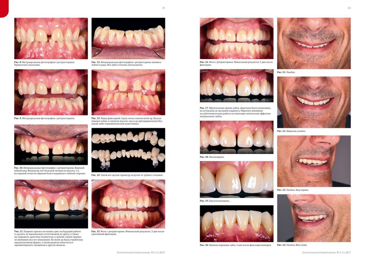 Clinical case Facets Reconstruction of blunt teeth and closure of the